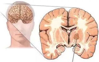 比較小的腫瘤不手術有哪些方法切除