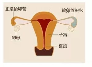 預防輸卵管積水的方法有哪些