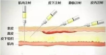藥物注射的方法有哪些