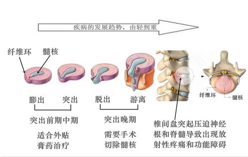 吊線風(fēng)的治療方法有哪些