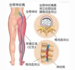 坐骨神經(jīng)痛有哪些鍛煉方法