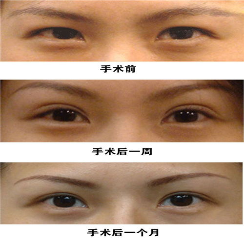 雙眼皮手術(shù)后恢復(fù)方法有哪些