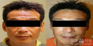 男生抬頭紋方法有哪些