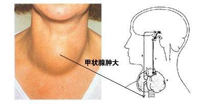 甲狀腺腫大的判斷方法有哪些