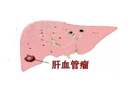 血管瘤用什么中藥最好的方法有哪些