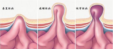 疝氣全麻手術后注意事項