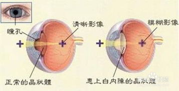白內(nèi)障術(shù)后飲食注意事項(xiàng)