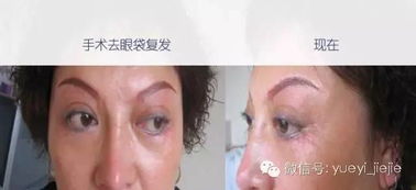 光波,離子,注意事項(xiàng),去眼袋