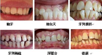 裝隱形牙后24小時(shí)注意事項(xiàng)