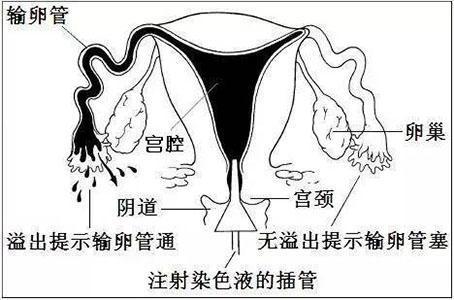 輸卵管造影檢查前注意事項(xiàng)