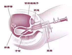 試管宮腔鏡注意事項(xiàng)