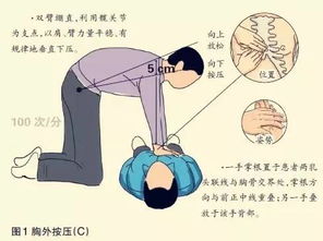 簡述胸外按壓注意事項(xiàng)