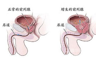 化療,注意事項(xiàng),前列腺癌