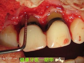 牙冠延長手術(shù)后注意事項(xiàng)