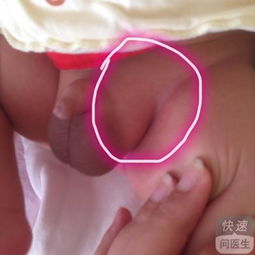 疝氣全麻手術后注意事項,小孩疝氣手術后注意事項8大要點要謹記,腹腔鏡疝氣手術后注意事項