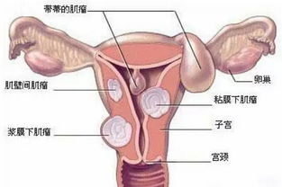 做了子宮肌瘤手術(shù)后注意事項(xiàng)