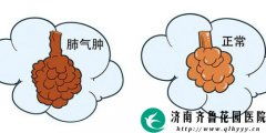 肺氣腫患者應(yīng)注意事項(xiàng),肺氣腫多喝水應(yīng)注意事項(xiàng),肺氣腫怕累嗎?應(yīng)注意事項(xiàng)