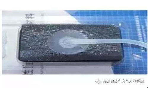 vsd負(fù)壓吸引術(shù)的注意事項(xiàng),vsd負(fù)壓吸引的目的及注意事項(xiàng),vsd負(fù)壓沖洗的注意事項(xiàng)