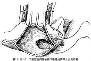 房間隔缺損手術(shù)注意事項