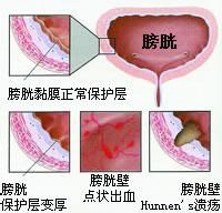 膀胱炎術后飲食注意事項