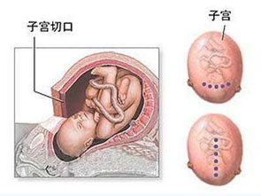 子宮破裂的注意事項