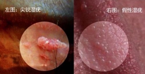 冷凍假性濕疣注意事項