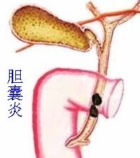 膽結(jié)石切膽后注意事項(xiàng)