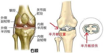 小孩膝蓋半月板損傷注意事項(xiàng)