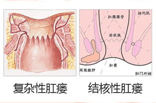 內(nèi)瘺的術后護理及注意事項,動靜脈內(nèi)瘺的護理與注意事項,肛瘺術后護理注意事項