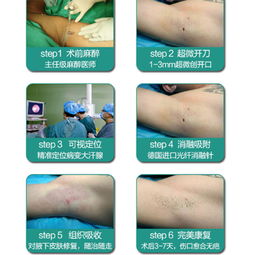 腋臭,術后,注意事項,微創(chuàng)