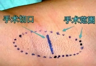 腋臭微創(chuàng)術后注意事項