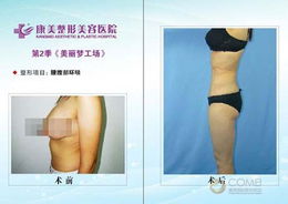 腰腹吸脂術(shù)后注意事項細(xì)節(jié),腹部吸脂術(shù)后注意事項,面部吸脂術(shù)后注意事項