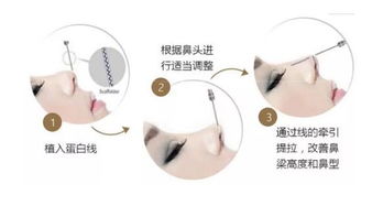 線雕鼻子后的注意事項,線雕鼻子注意事項有哪些,鼻子做線雕的注意事項