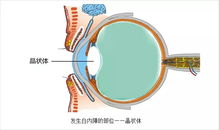 遺傳性,白內(nèi)障,注意事項(xiàng)