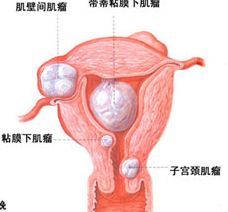 直腸息肉灌腸注意事項