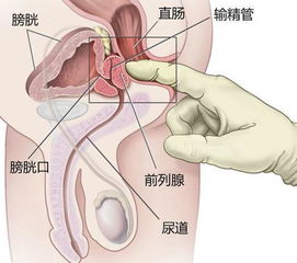 前列腺結(jié)石注意事項