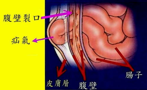 小孩能不能做疝氣手術(shù),小孩做疝氣手術(shù)過程,小孩疝氣需要做手術(shù)嗎