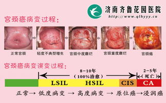 tct和hpv檢查后注意事項(xiàng),做完tct檢查后注意事項(xiàng),tct檢查前注意事項(xiàng)