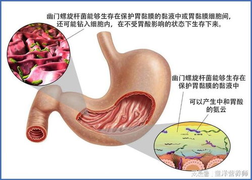 吃治療幽門桿菌的藥注意事項(xiàng)