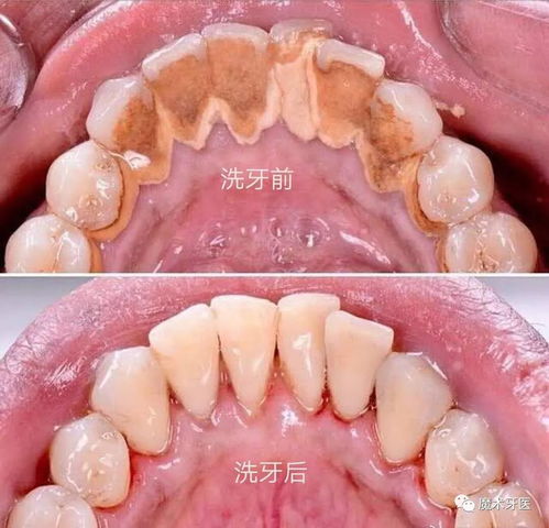 牙周炎洗牙后注意事項(xiàng)