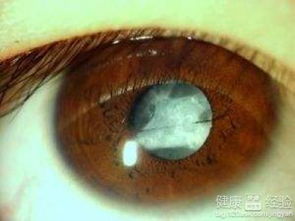 雙眼黃斑前膜的注意事項