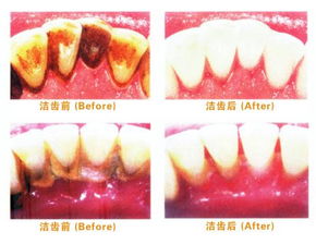牙周炎第一次洗牙后注意事項(xiàng),牙周炎洗完牙后注意事項(xiàng),牙周炎治療后注意事項(xiàng)