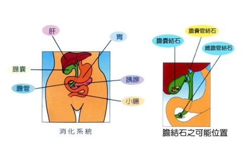 膽結石注意事項及飲食,膽結石患者注意事項,膽結石微創(chuàng)手術注意事項