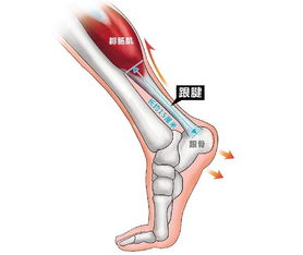跟腱斷裂手術(shù)前后注意事項(xiàng)