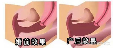 緊縮,術(shù)后,陰道,注意事項(xiàng)