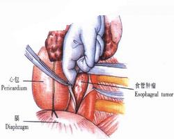 賁門癌手術(shù)后注意事項(xiàng)