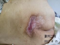 預防壓瘡的注意事項,壓瘡換藥的注意事項,壓瘡的護理要點及注意事項