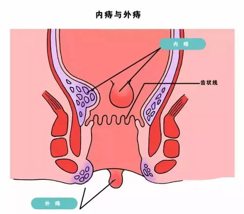 痔瘡手術(shù)后應(yīng)注意事項(xiàng)