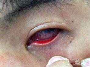 結(jié)膜炎注意事項和如何恢復(fù),結(jié)膜炎一般多久能好結(jié)膜炎注意事項,結(jié)膜炎日常注意事項