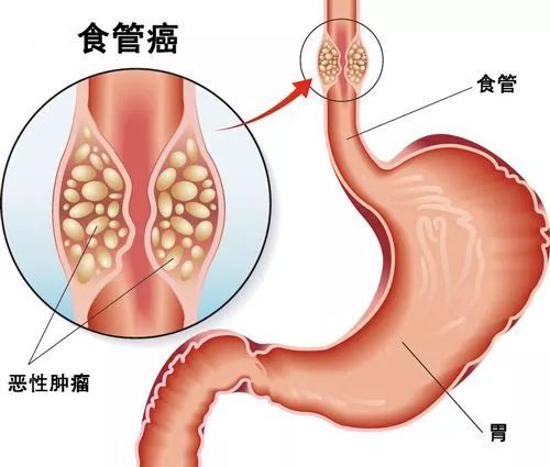 食道癌,注意事項(xiàng),插管